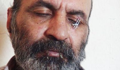 BM'yi protesto için ağzı ve kulaklarından sonra gözünü de dikti